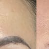 Three Sessions Of Laser Tattoo Removal: Small, Medium, Or Large Area Dubai - Image 6