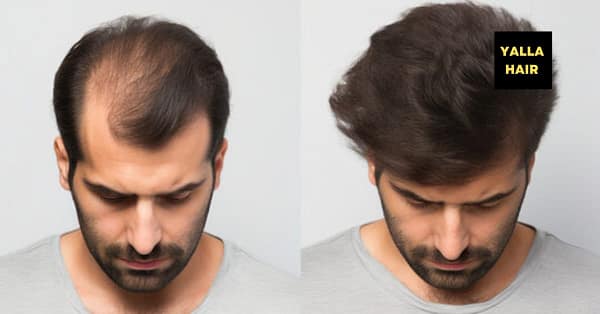 Extensions / Feathering Dubai